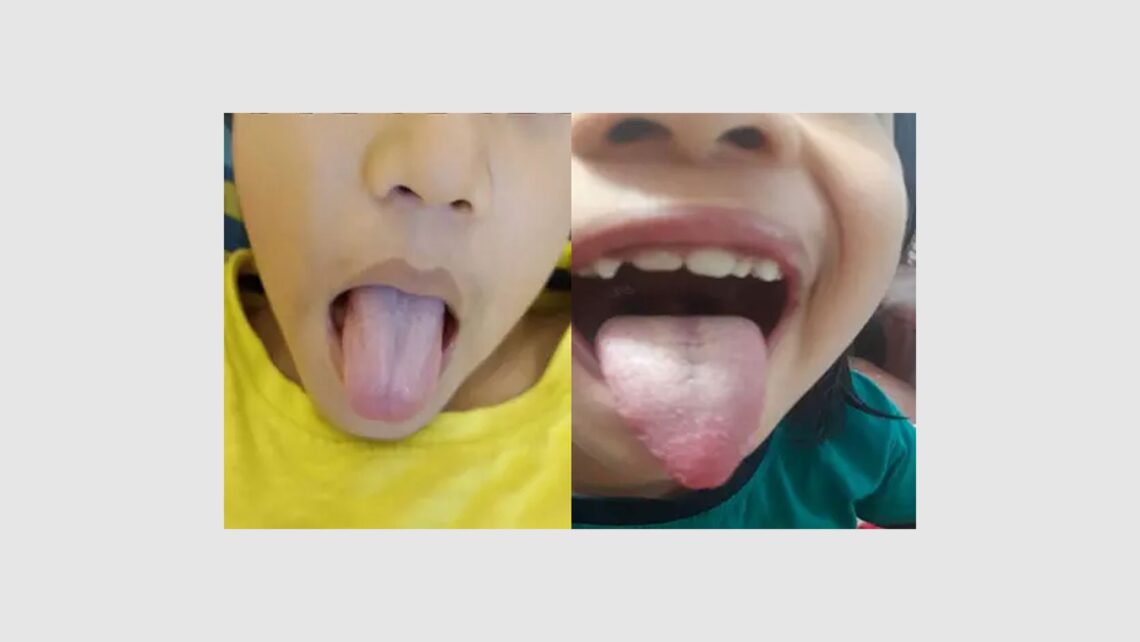 Role of Objective Signs for prescribing in Acute Diseases